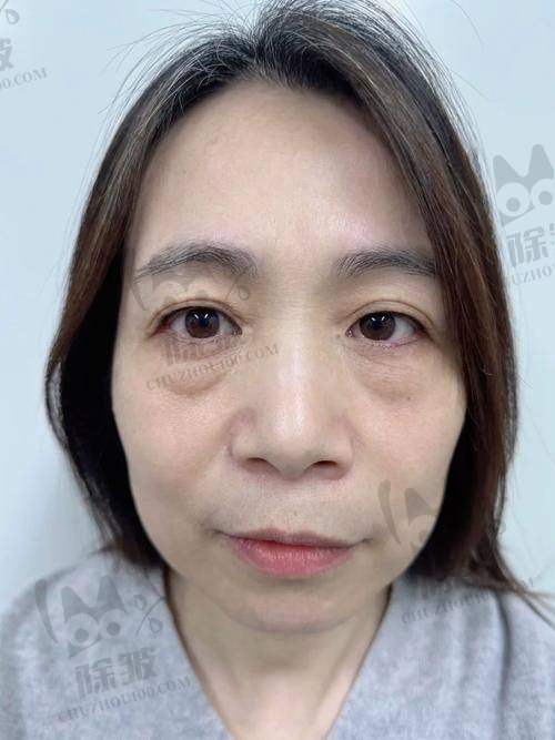 昆山容妍整形柴云医生技术优势