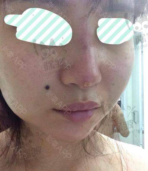 崔宇景医生技术优势