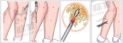 4. 选择建议:如何找到靠谱的除皱机构