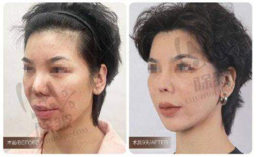 杭州联合丽格第六医疗美容医院乔雅登丰颜玻尿酸口碑评价